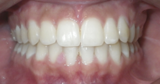 Perfect Teeth After Dental Treatment